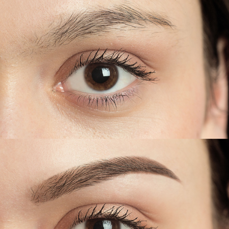 Eyebrow Reconstruction