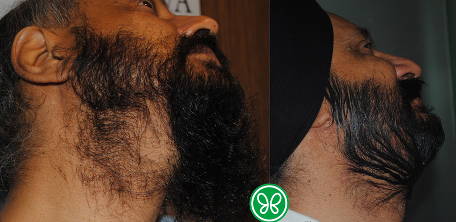 Beard Hair Transplant in Chandigarh