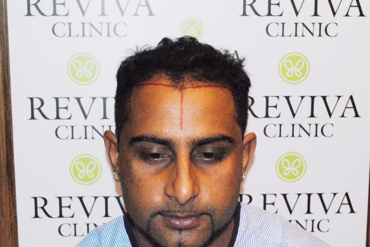 Dr Naiya Bansal's best Laser hair Clinic Chandigarh - Laser Hair Removal  Service