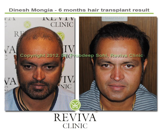 Top Hair Transplant in Chandigarh | NeoGraft Hair Clinic led by Dr. Nav  Vikram