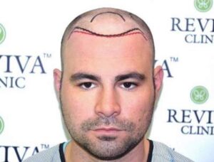 Hair Transplant In Chandigarh, India | Reviva Clinic